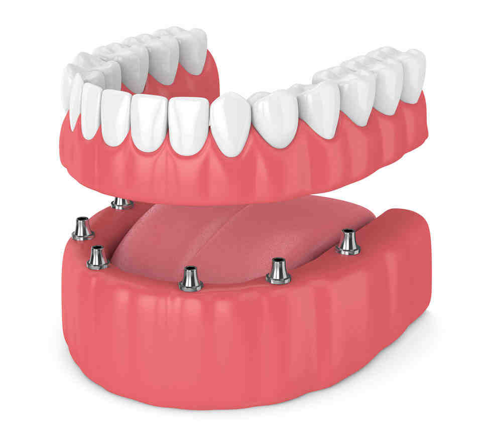 Can partials ruin your teeth?