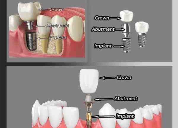 Can putting on a crown an upper dental implant cause sinus pressure