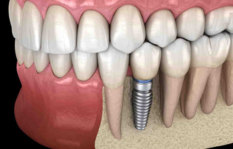 Can root canal be done twice?