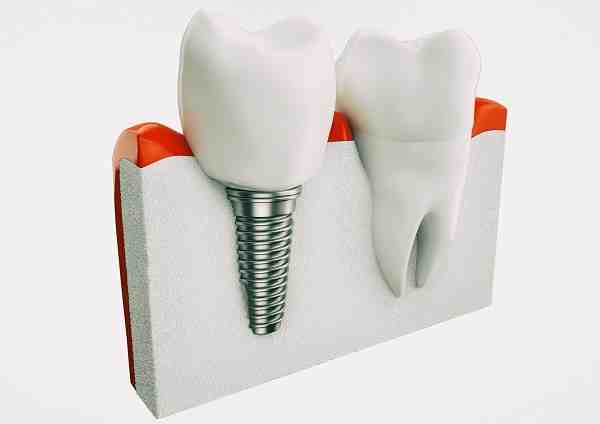 Can screws in bones come loose?