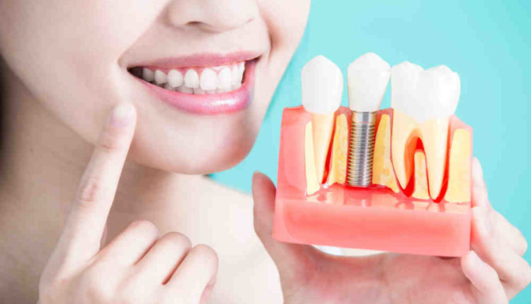 Can stains on dental implant be removed?