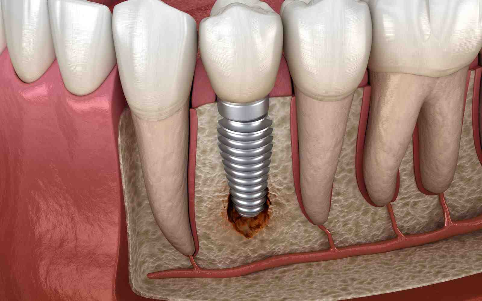 Can teeth be saved with periodontal disease?