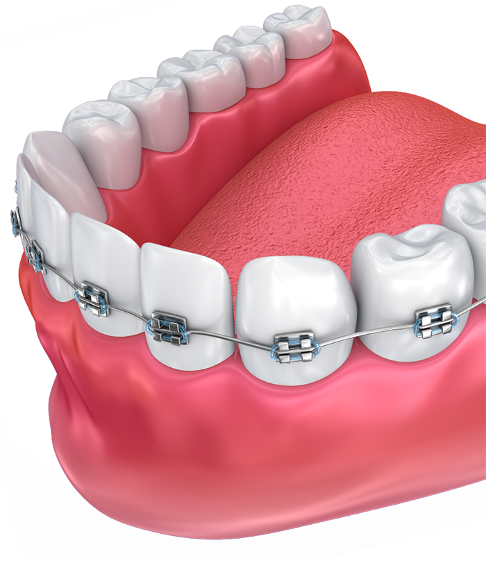 Can teeth be too weak for braces?
