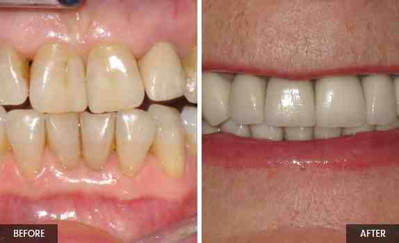 Can teeth decay under a bridge?