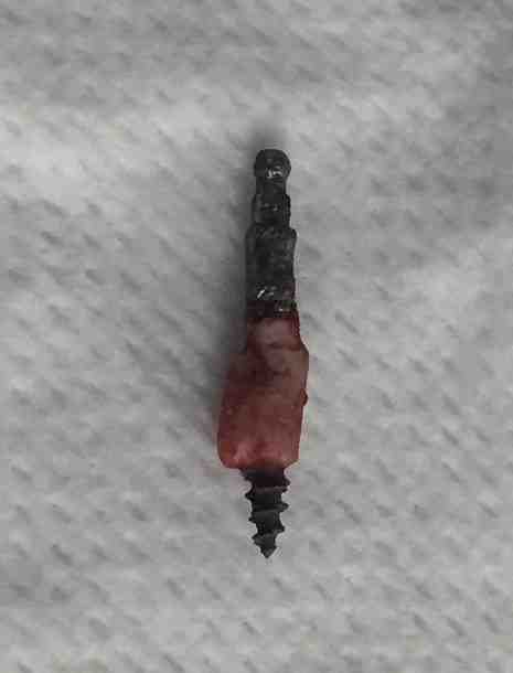 Can titanium dental implants cause cancer?