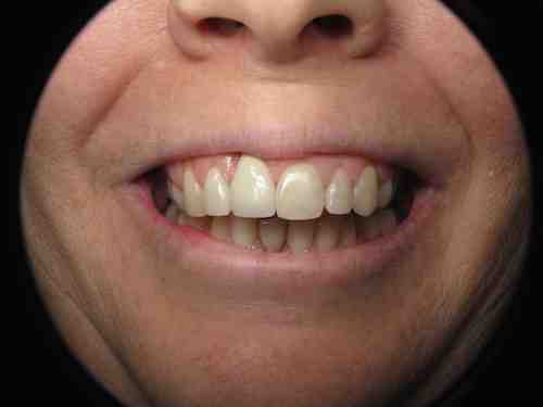 Can veneers be too white?