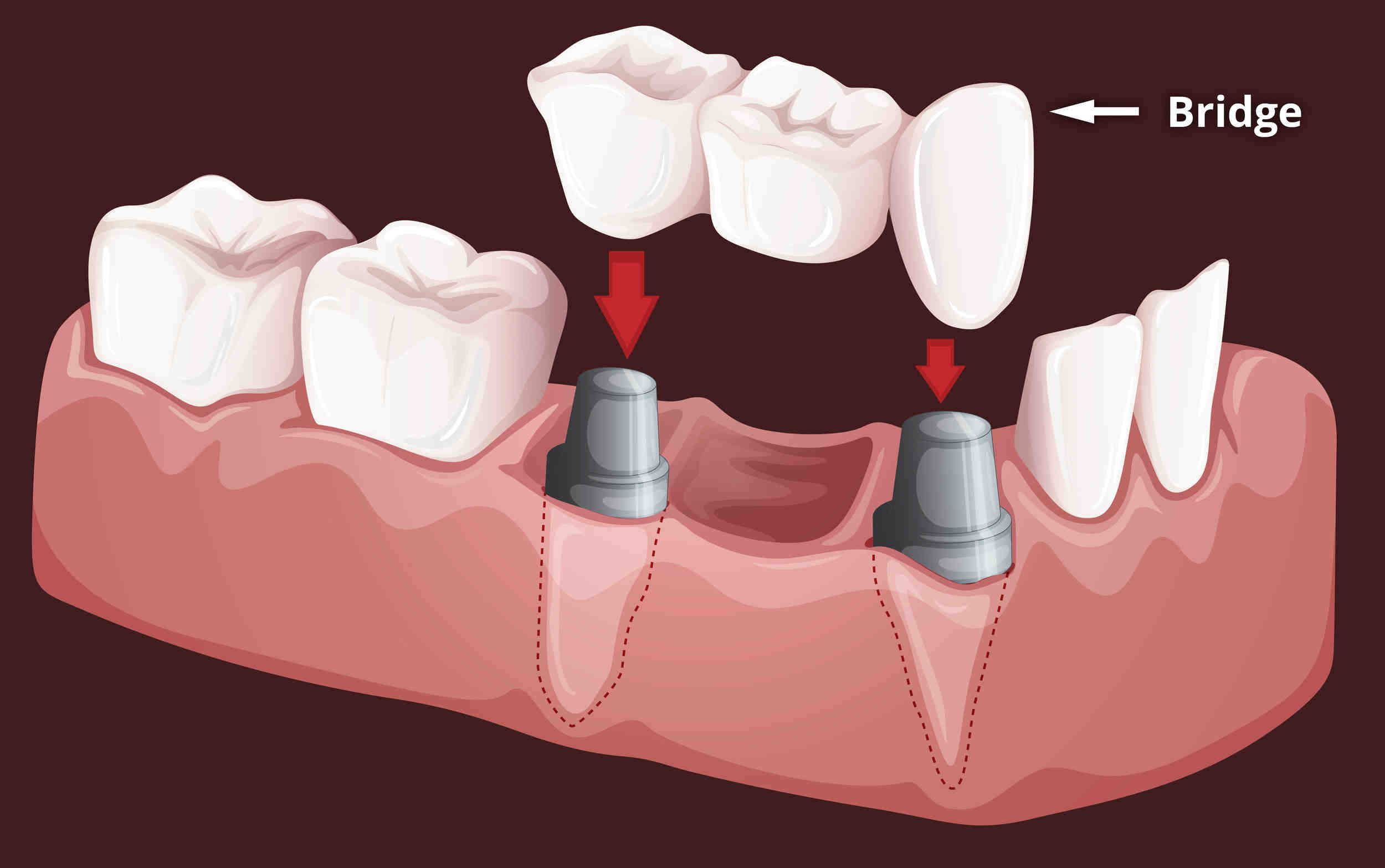 Can you be too old for teeth implants?