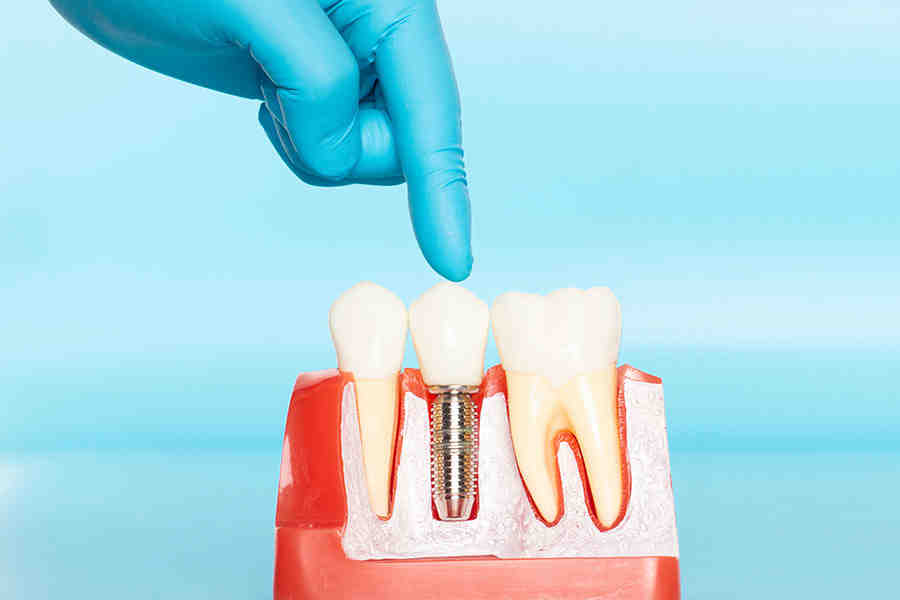 Can you brush implants with toothpaste?