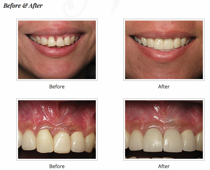 Can you brush implants with toothpaste?