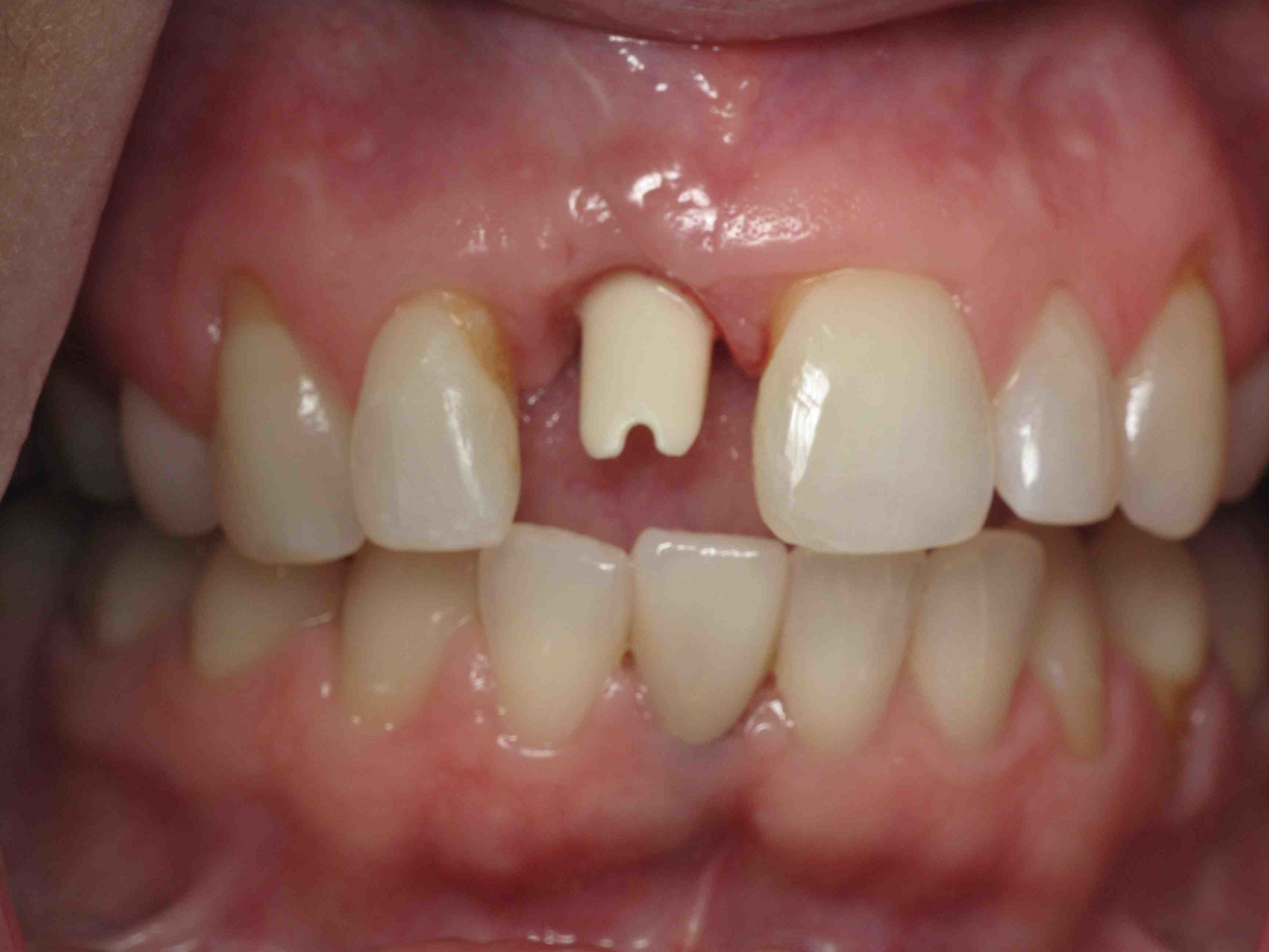 Can you change the crown on teeth?
