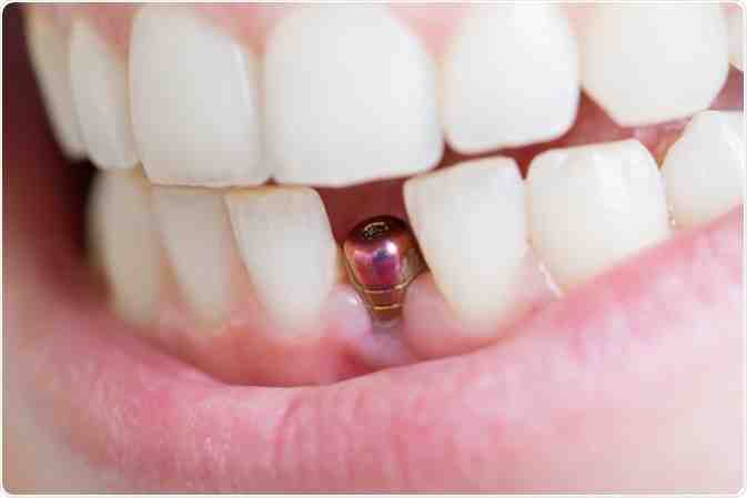 Can you chew gum with implants?