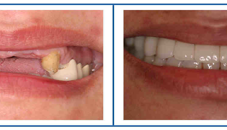 Can you do your own dental implants