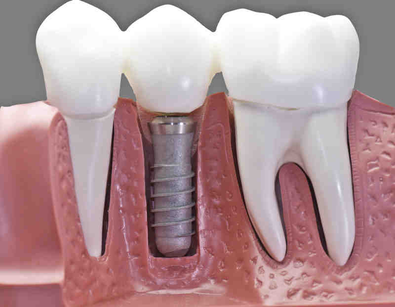 Can you feel screws in bone?