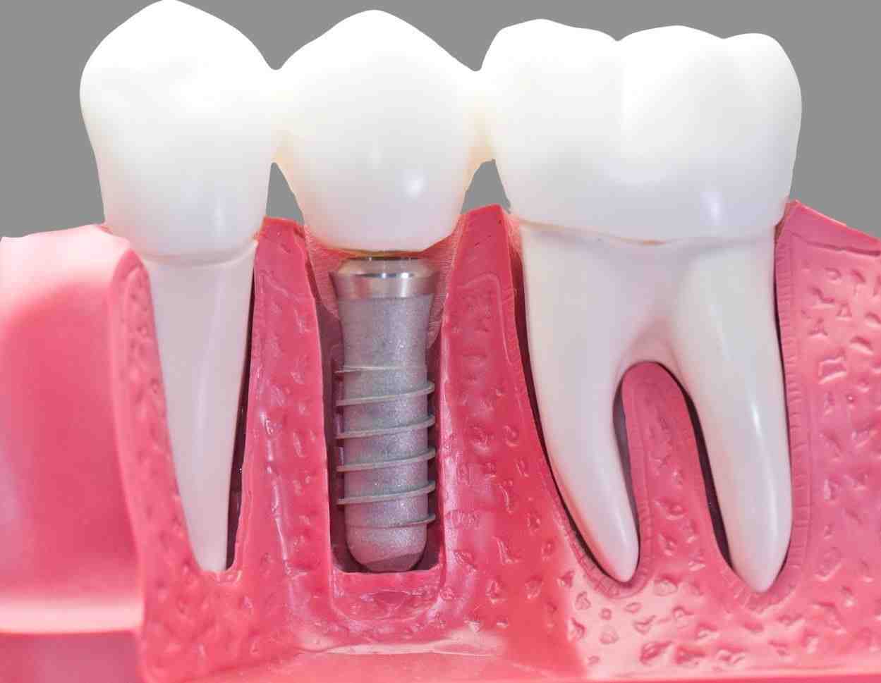 Can you fix a failed implant?