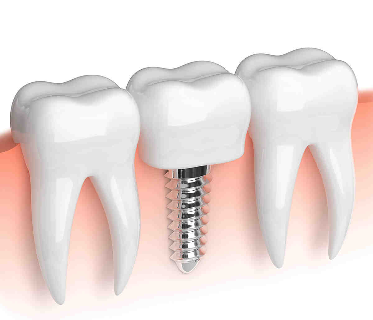 Can you fix a single tooth?