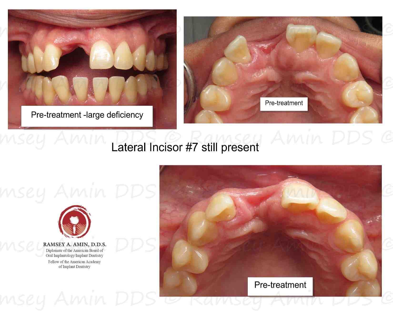 Can you get a bone graft and not get an implant?