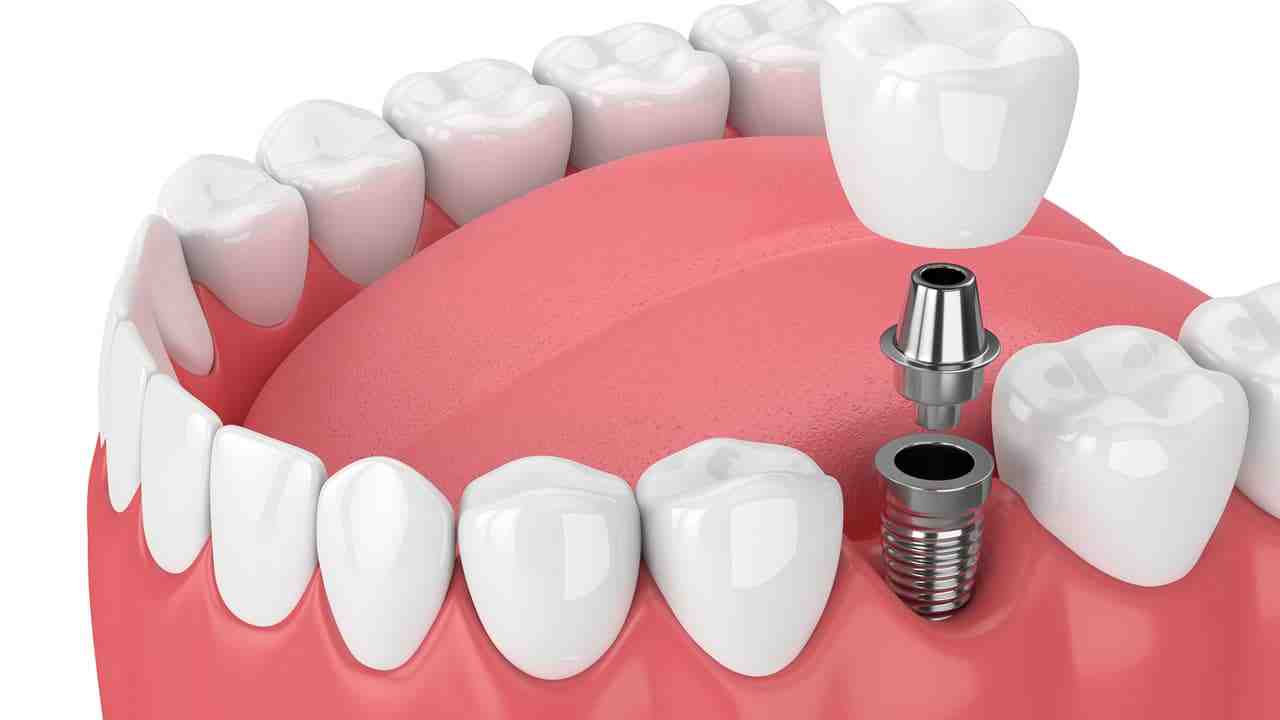 Can you get a cavity in a dental implant?