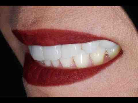 Can you get a full mouth of dental implants?