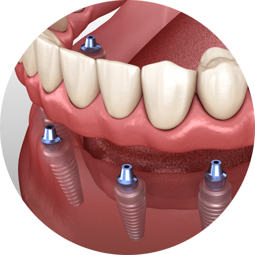 Can you get a full mouth of dental implants?