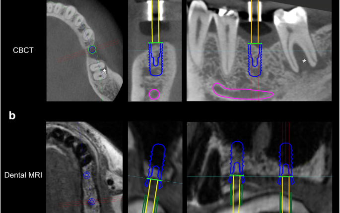 Can You Get An Mri With Dental Implants - Dental News Network