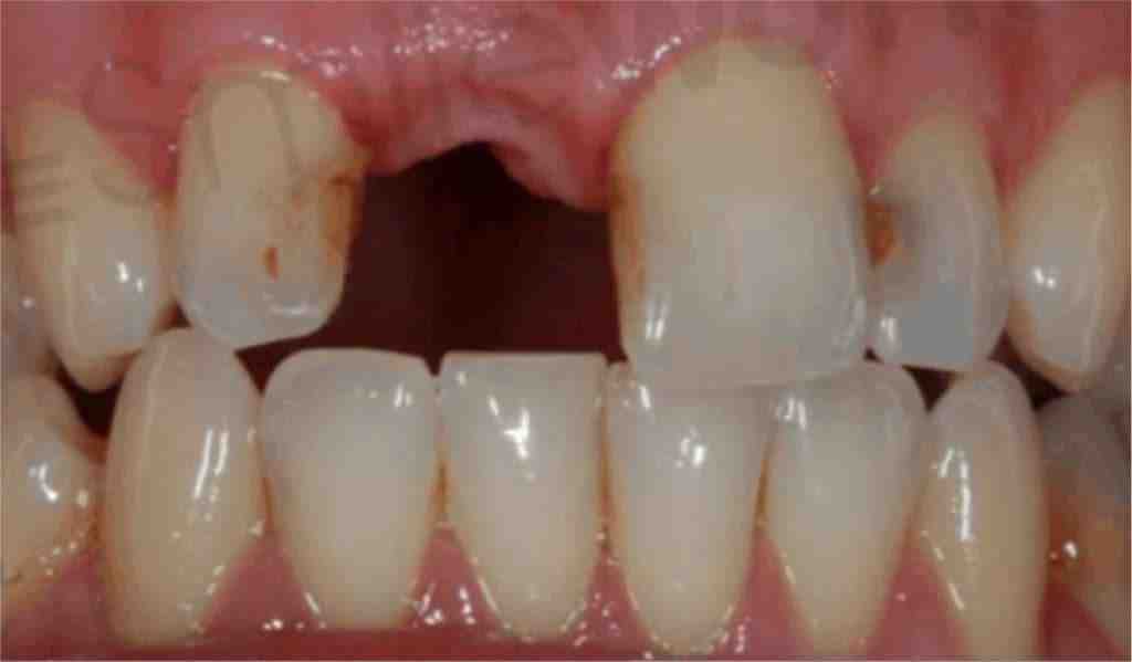 Can you get cavities with implants?