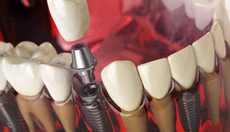 Can you get dental implants if on blood thinners