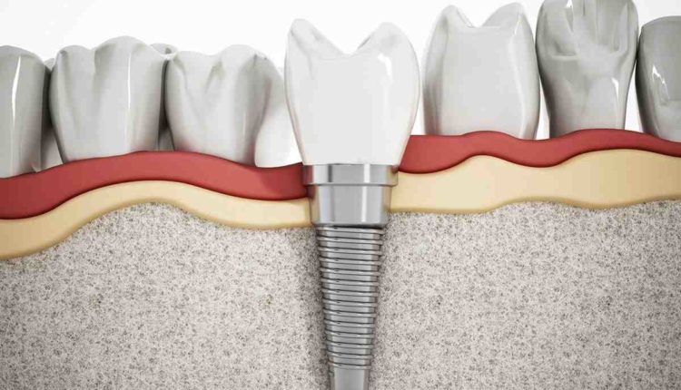 Can you get metal poisoning from dental implants