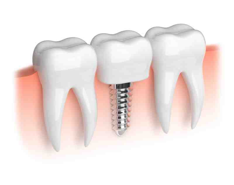 Can you get tartar with dental implants?