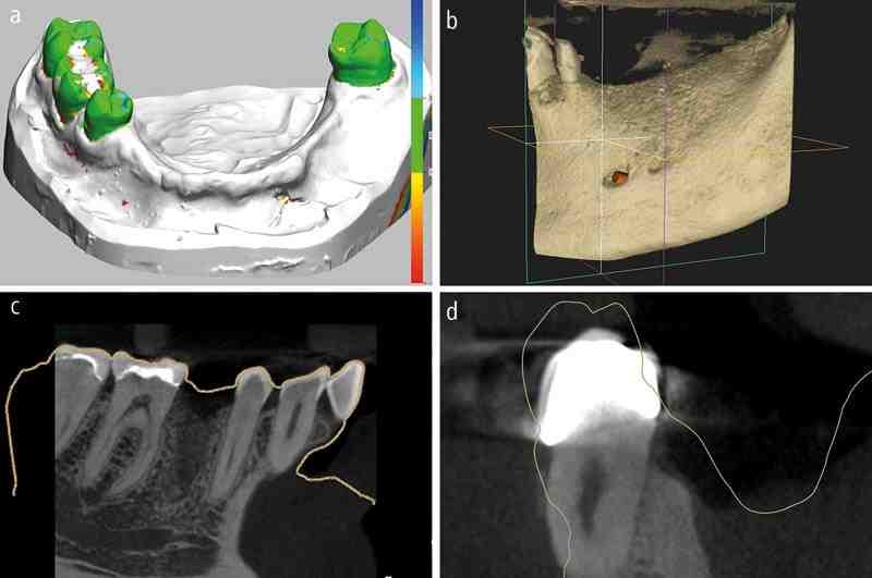 Can you have 2 teeth on one implant?