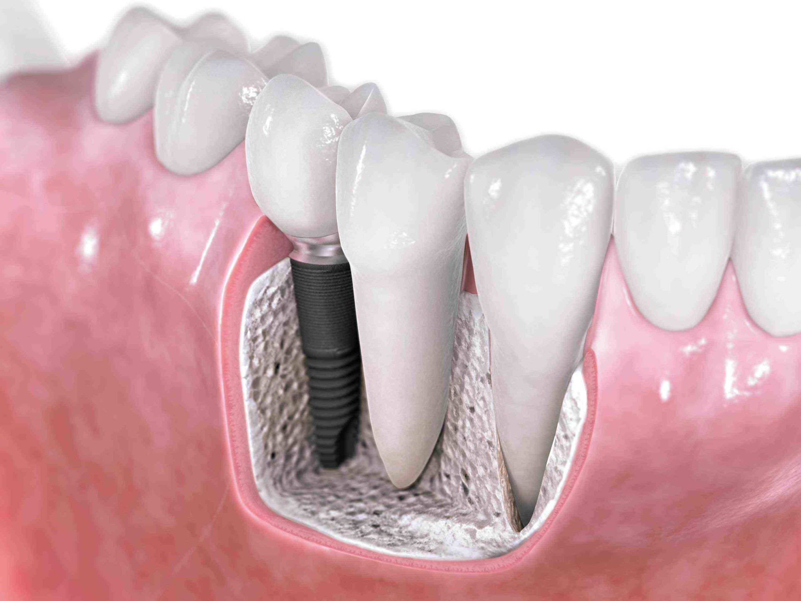 Can you have 3 dental implants next to each other?