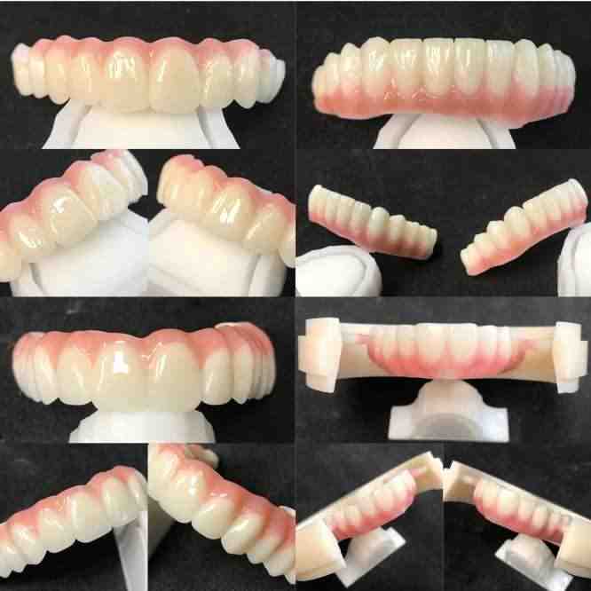 Can you replace all teeth with implants?