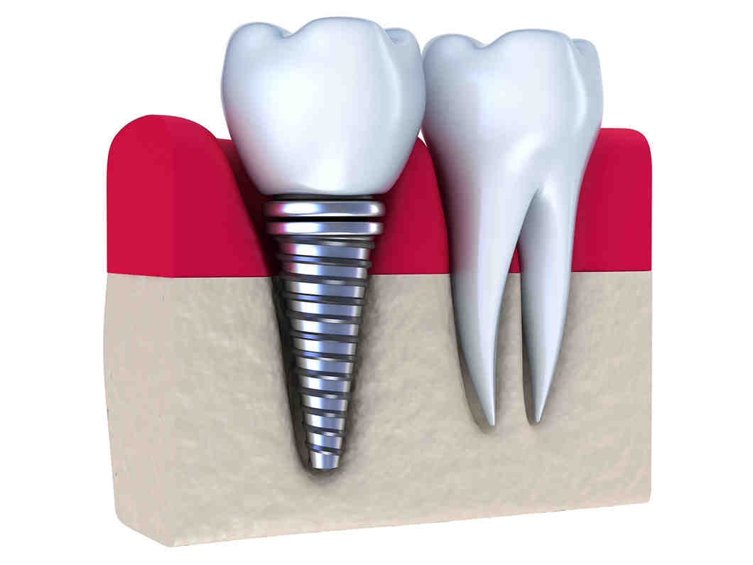 Can you replace all teeth with implants?