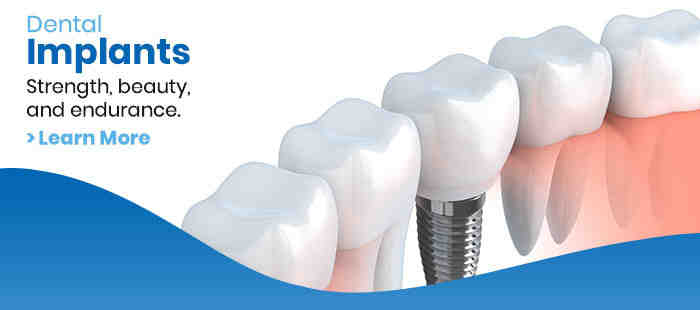 Can you replace all teeth with implants?