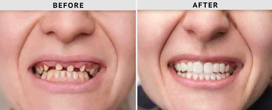 Can you replace all your teeth with implants?