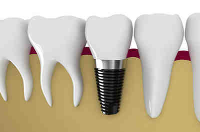 Can you replace root canal with implant?
