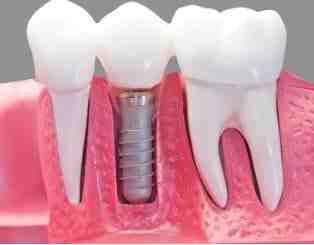 Can you reverse periodontal disease?