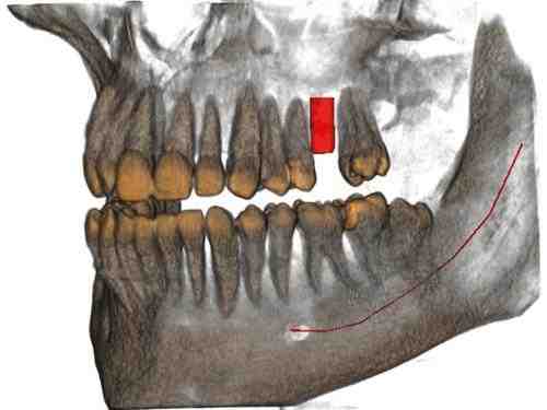 Can you sharpen implant scalers?