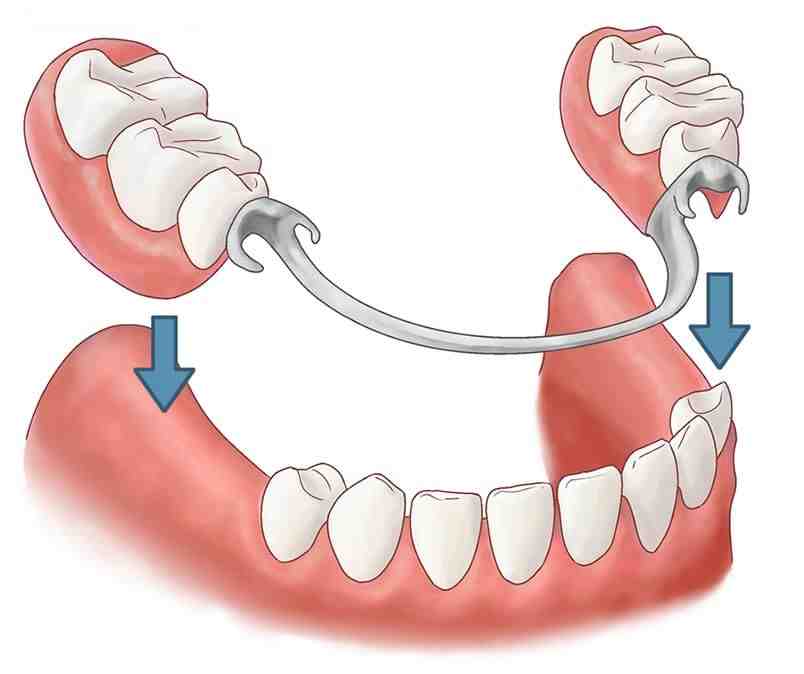 Can you sleep with partial dentures in your mouth?