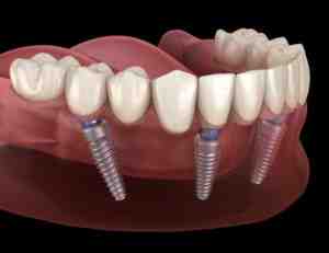 Can you wear dentures if you have bone loss?