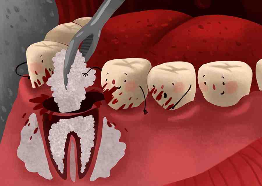 Can your body reject dental bone graft?
