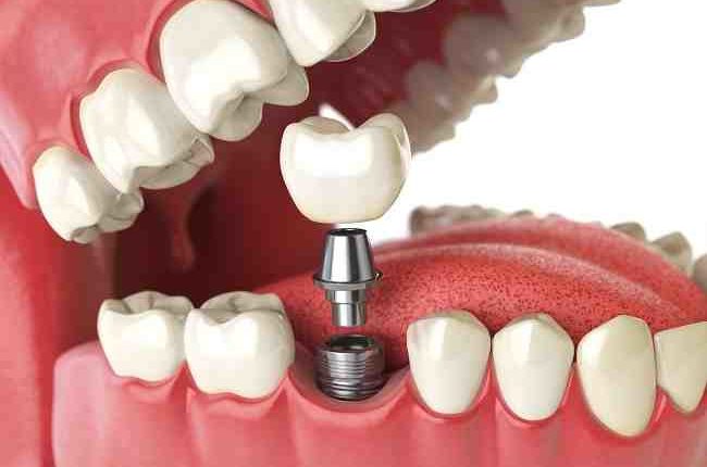 Cost of dental implants in cuba?
