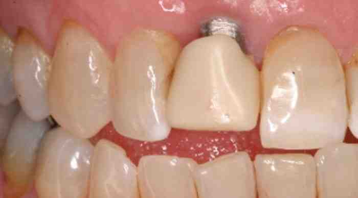 Do I need a bone graft if I'm not getting an implant?