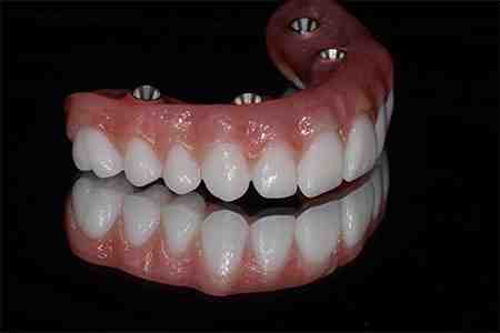 Do all celebrities have veneers?