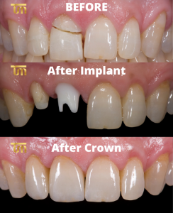 Do all celebrities have veneers?
