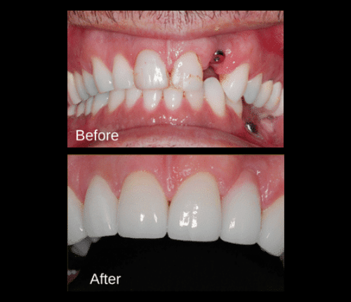 Do all upper dental implants require a sinus lift?