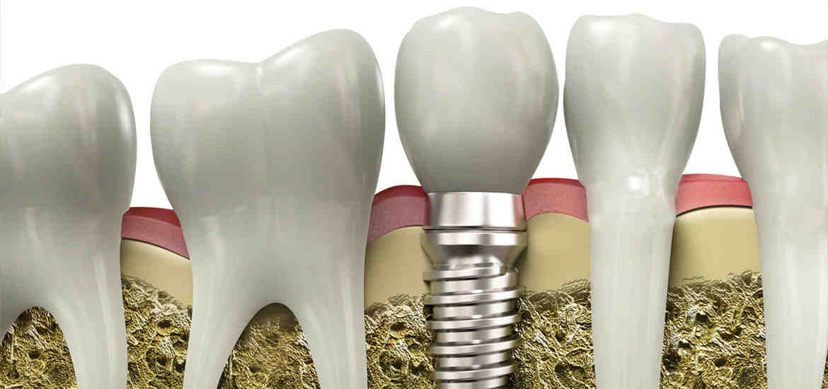 Do celebrities have dental implants?