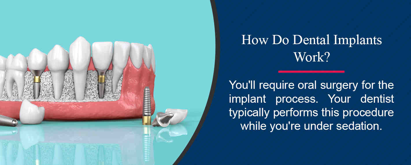 Do dental bridges cause bone loss?