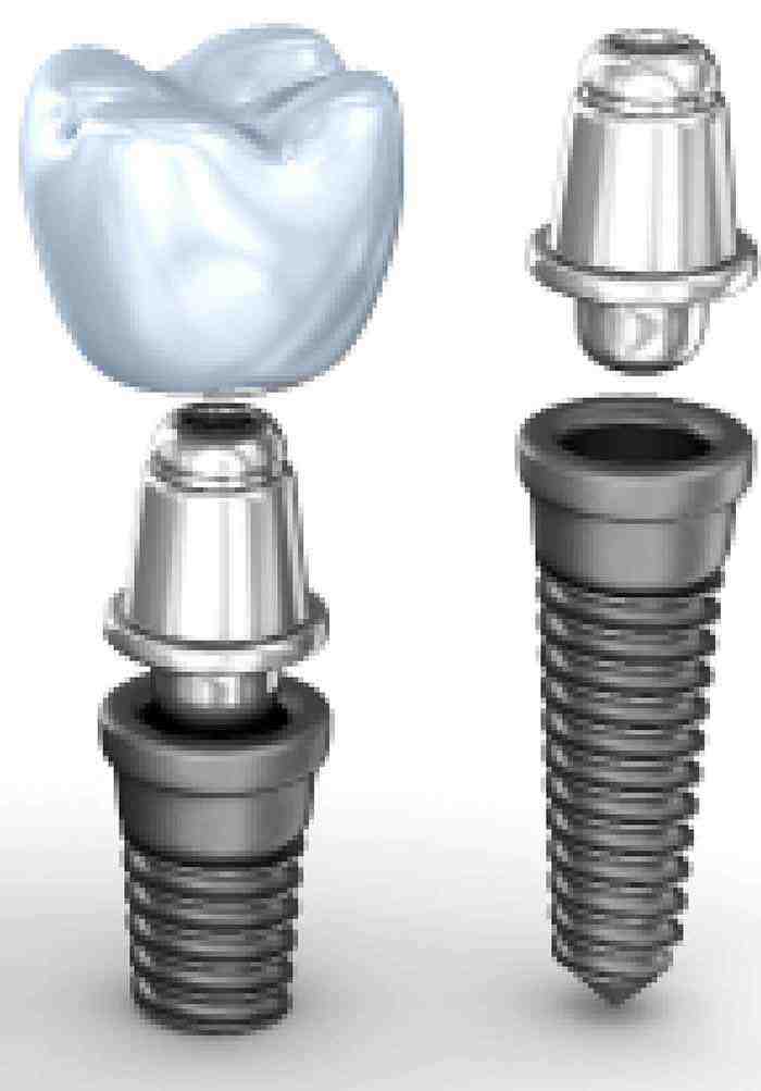 Do dental implants cause health problems?