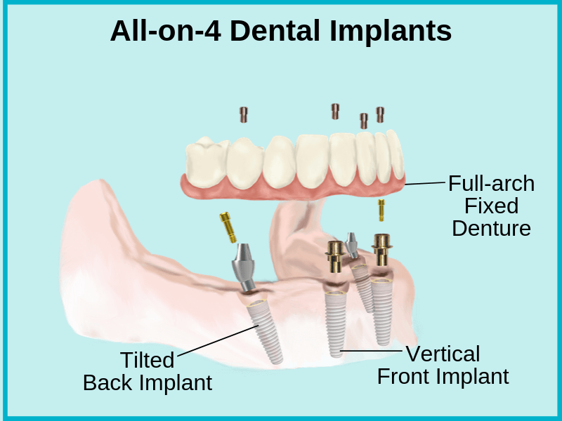 Do dental implants decay?