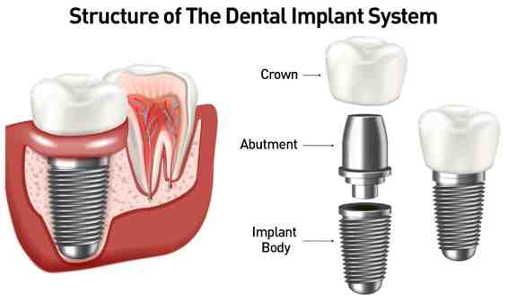Do dental implants get cavities?